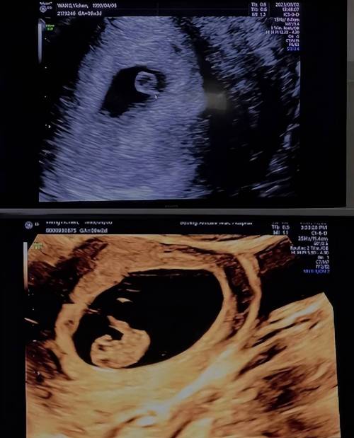 孕期频繁做B超安全吗？会对胎儿发育有影响吗？-第1张图片-郑州医学网