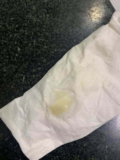 备孕期白带腥味豆腐渣是妇科炎症信号吗？会影响怀孕吗？-第3张图片-郑州医学网