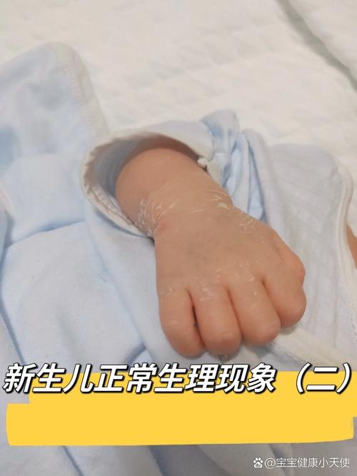 新生儿几种特殊生理状态是疾病信号还是正常发育现象?-第2张图片-郑州医学网 新生儿几种特殊生理状态是疾病信号还是正常发育现象?-第2张图片-郑州医学网