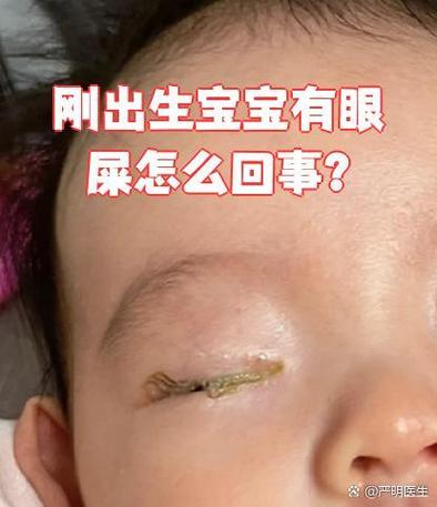新生儿眼睛肿又流眼泪,是正常生理现象还是需要警惕的健康信号?-第3张图片-郑州医学网 新生儿眼睛肿又流眼泪,是正常生理现象还是需要警惕的健康信号?-第3张图片-郑州医学网