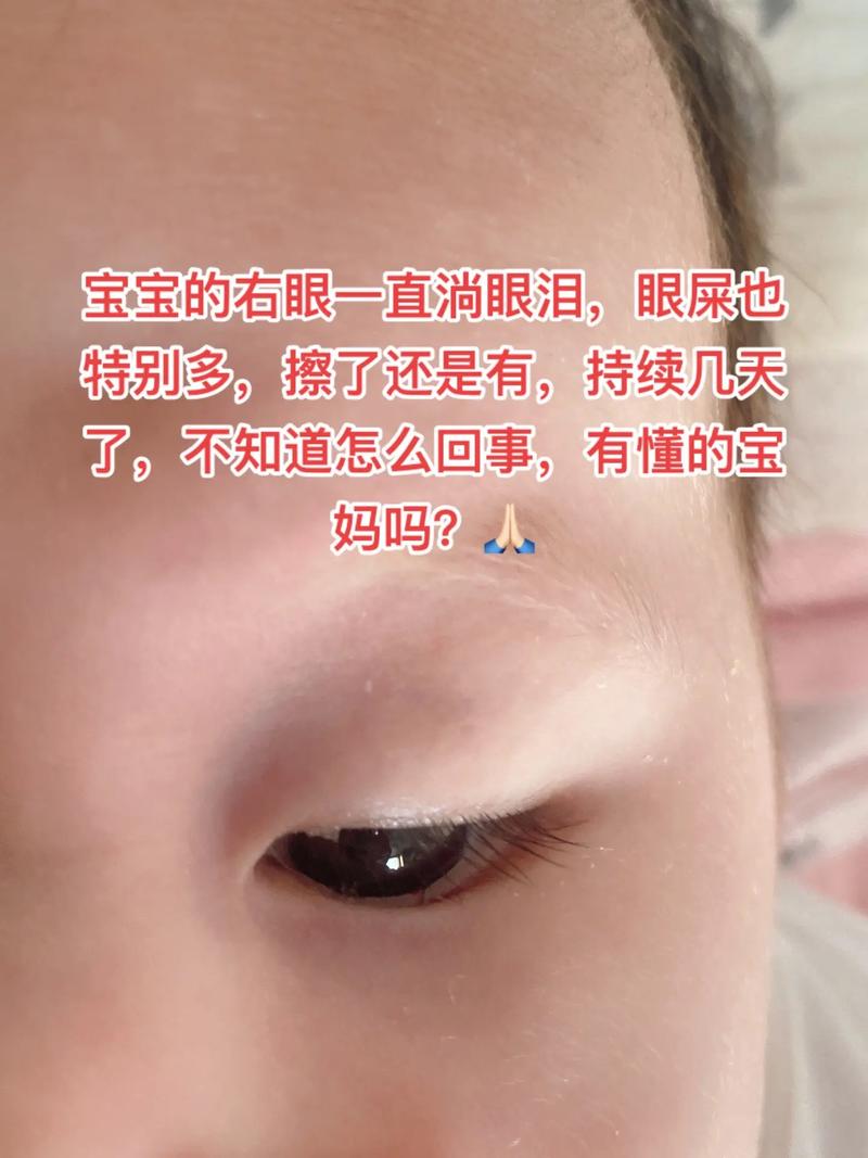 新生儿眼睛肿又流眼泪，是正常生理现象还是需要警惕的健康信号？-第2张图片-郑州医学网