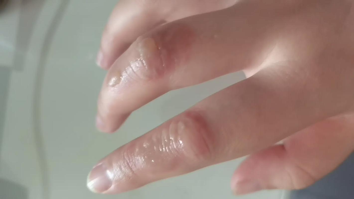 孕期手肿发痒是正常现象吗?需警惕哪些潜在健康问题?-第3张图片-郑州医学网 孕期手肿发痒是正常现象吗?需警惕哪些潜在健康问题?-第3张图片-郑州医学网