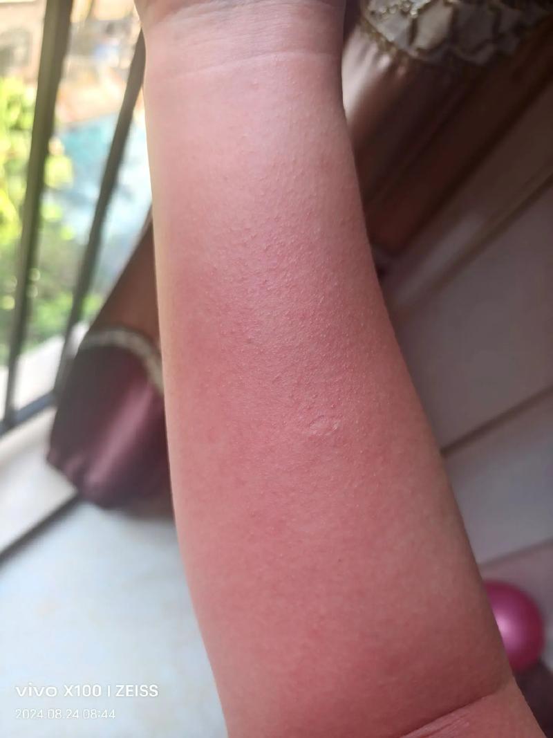 孕期手肿发痒是正常现象吗？需警惕哪些潜在健康问题？-第2张图片-郑州医学网