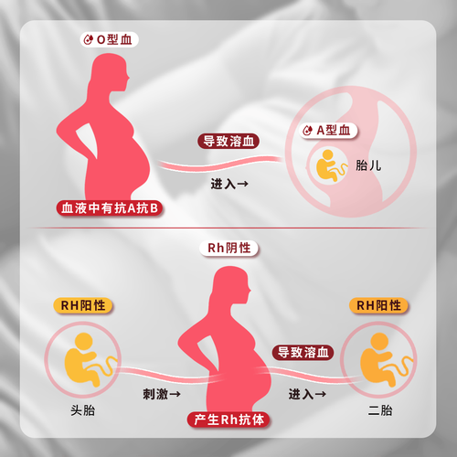 新生儿溶血为何不出现黄疸？是特殊情况还是漏诊信号？-第1张图片-郑州医学网