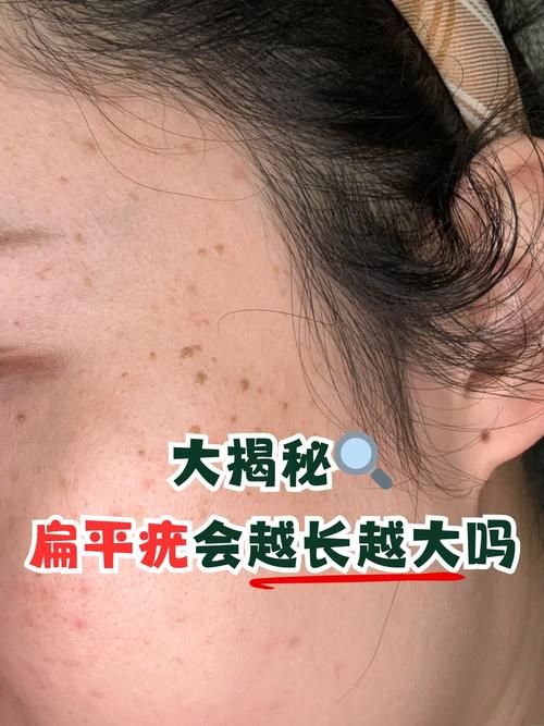 孕期扁平疣能不能治？安全治疗方法和注意事项有哪些？-第2张图片-郑州医学网