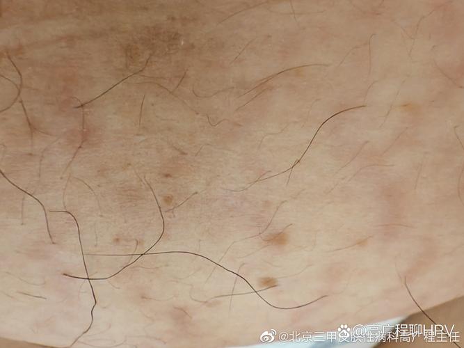 孕期扁平疣能不能治？安全治疗方法和注意事项有哪些？-第1张图片-郑州医学网