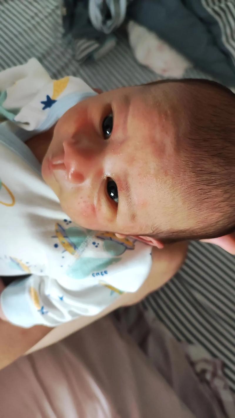 新生儿脸上有小红点白头是湿疹还是痤疮？该如何正确护理？-第1张图片-郑州医学网