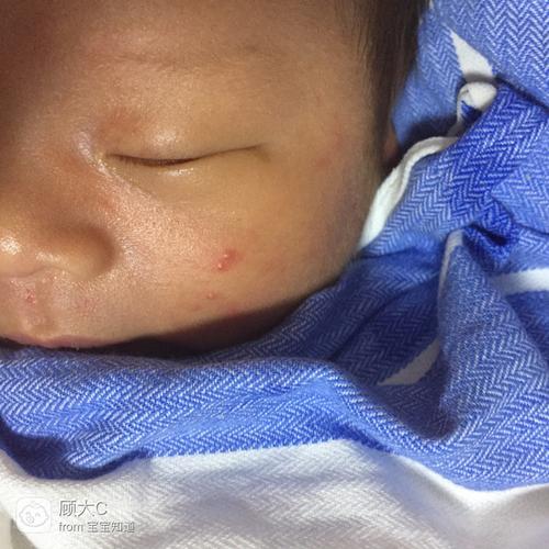 新生儿脸上有小红点白头是湿疹还是痤疮？该如何正确护理？-第2张图片-郑州医学网