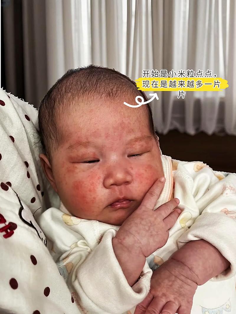新生儿脸上有小红点白头是湿疹还是痤疮？该如何正确护理？-第3张图片-郑州医学网