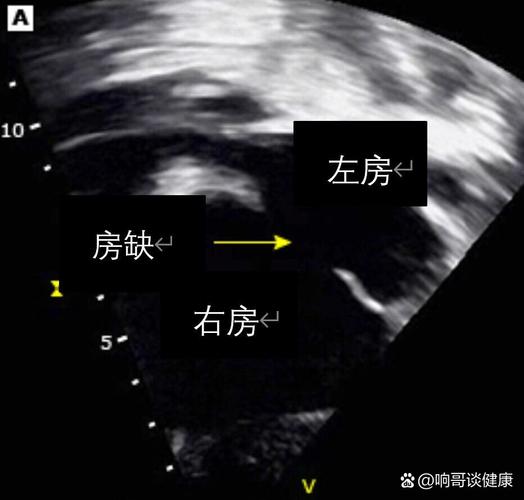 2mm新生儿房缺需要干预吗?能自行闭合吗?对生长发育有影响吗?-第1张图片-郑州医学网 2mm新生儿房缺需要干预吗?能自行闭合吗?对生长发育有影响吗?-第1张图片-郑州医学网