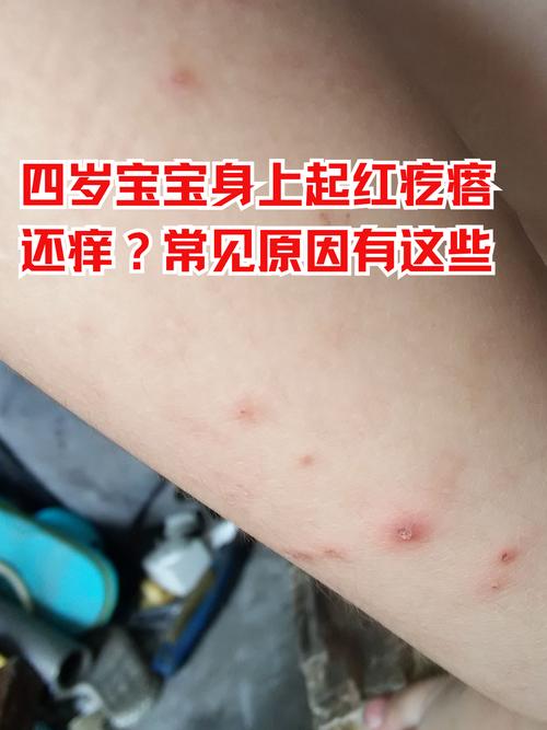 儿童皮肤过敏红痒难忍？家长该如何科学护理与快速缓解？-第3张图片-郑州医学网