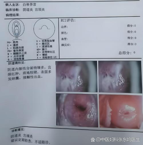 孕期白带呈豆渣样还痒,会不会是霉菌感染?对胎儿有影响吗?该怎么护理和治疗?-第2张图片-郑州医学网 孕期白带呈豆渣样还痒,会不会是霉菌感染?对胎儿有影响吗?该怎么护理和治疗?-第2张图片-郑州医学网