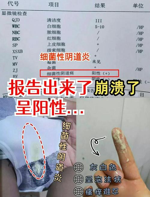 孕期白带呈豆渣样还痒,会不会是霉菌感染?对胎儿有影响吗?该怎么护理和治疗?-第1张图片-郑州医学网 孕期白带呈豆渣样还痒,会不会是霉菌感染?对胎儿有影响吗?该怎么护理和治疗?-第1张图片-郑州医学网