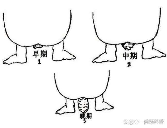 儿童脱肛最佳治疗方法有哪些？不同年龄段如何选择安全有效的方案？-第2张图片-郑州医学网