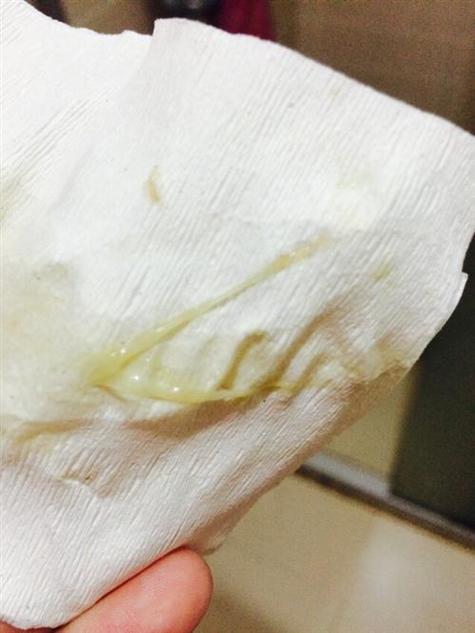 孕期白带发黄有腥臭味是感染了吗?对胎儿有影响吗?该怎么办?-第2张图片-郑州医学网 孕期白带发黄有腥臭味是感染了吗?对胎儿有影响吗?该怎么办?-第2张图片-郑州医学网