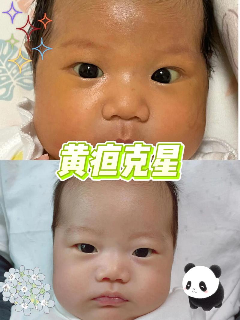 新生儿眼白发黄是正常现象吗？需要警惕哪些潜在健康问题？-第3张图片-郑州医学网