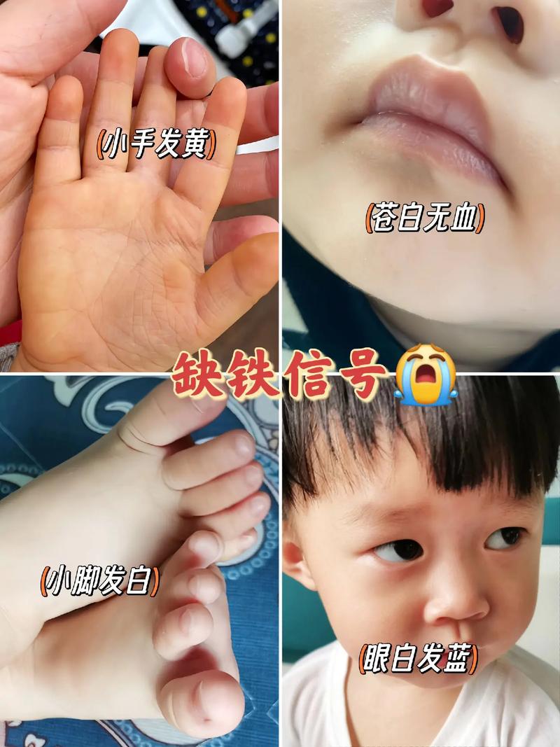 新生儿眼白发黄是正常现象吗？需要警惕哪些潜在健康问题？-第2张图片-郑州医学网