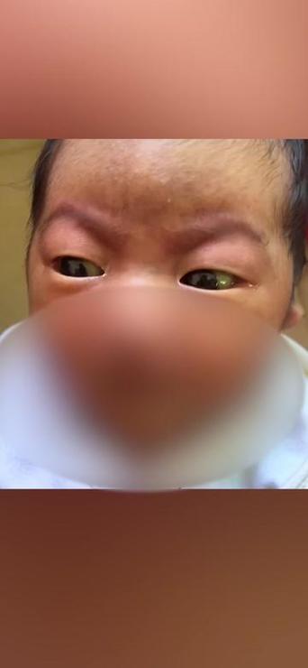 新生儿眼白发黄是正常现象吗？需要警惕哪些潜在健康问题？-第1张图片-郑州医学网