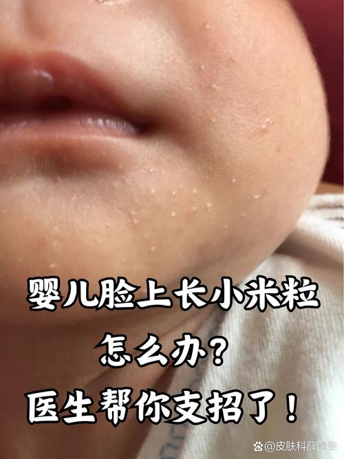 新生儿脸上长白色疙瘩是湿疹还是其他皮肤问题?需要治疗吗?-第1张图片-郑州医学网 新生儿脸上长白色疙瘩是湿疹还是其他皮肤问题?需要治疗吗?-第1张图片-郑州医学网