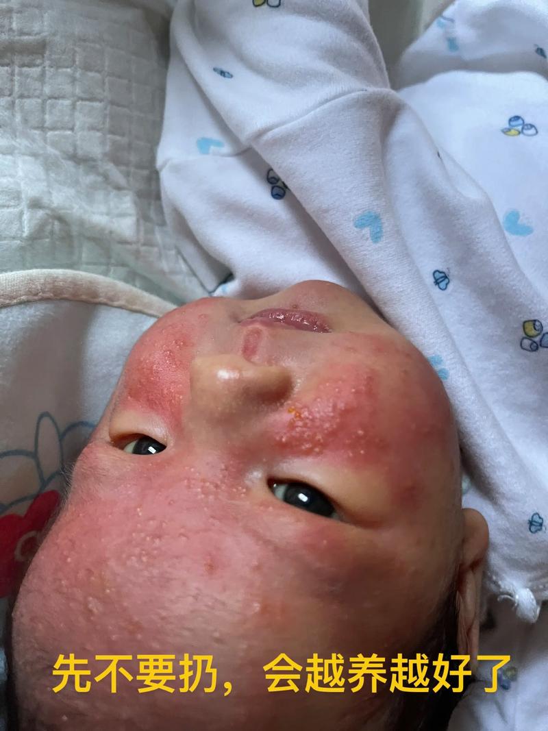 新生儿脸上长白色疙瘩是湿疹还是其他皮肤问题?需要治疗吗?-第2张图片-郑州医学网 新生儿脸上长白色疙瘩是湿疹还是其他皮肤问题?需要治疗吗?-第2张图片-郑州医学网