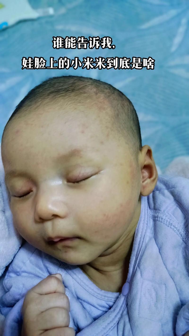 新生儿脸上长白色疙瘩是湿疹还是其他皮肤问题?需要治疗吗?-第3张图片-郑州医学网 新生儿脸上长白色疙瘩是湿疹还是其他皮肤问题?需要治疗吗?-第3张图片-郑州医学网