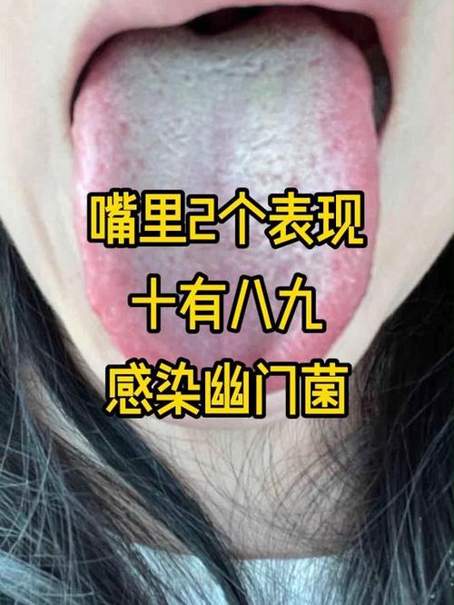 儿童感染幽门螺杆菌有哪些典型症状?家长该如何早期发现与应对?-第2张图片-郑州医学网 儿童感染幽门螺杆菌有哪些典型症状?家长该如何早期发现与应对?-第2张图片-郑州医学网
