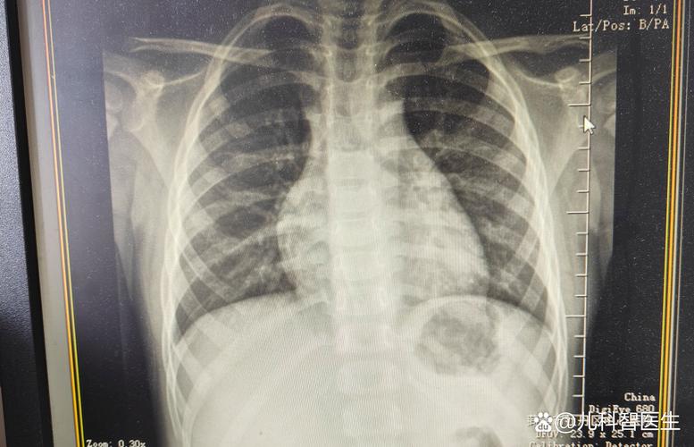 儿童支原体感染有哪些检查方法？不同检查方式适用哪些情况？-第1张图片-郑州医学网