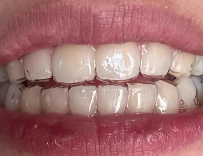 孕期牙齿保持器佩戴安全吗?对胎儿发育有潜在影响吗?-第1张图片-郑州医学网 孕期牙齿保持器佩戴安全吗?对胎儿发育有潜在影响吗?-第1张图片-郑州医学网