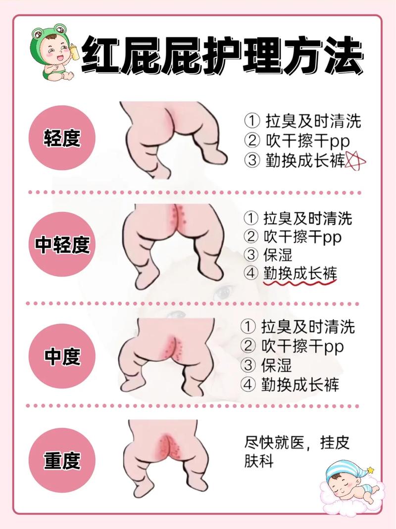 新生儿红屁股反反复复总不好，到底该怎么办才能有效护理？-第3张图片-郑州医学网