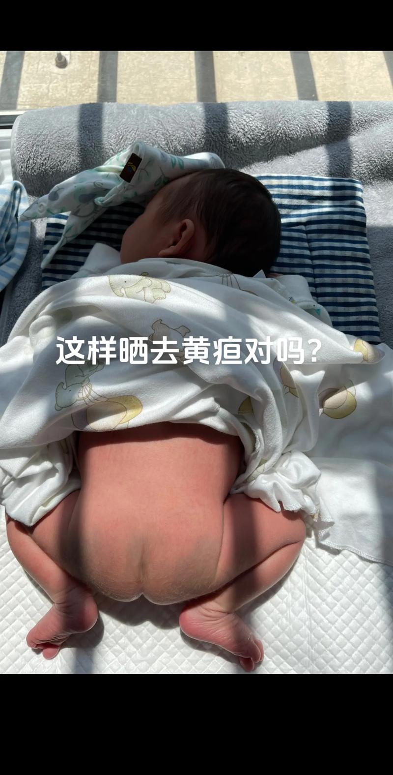 新生儿晒黄疸该晒哪里？晒背部还是晒胸部更有效？-第1张图片-郑州医学网