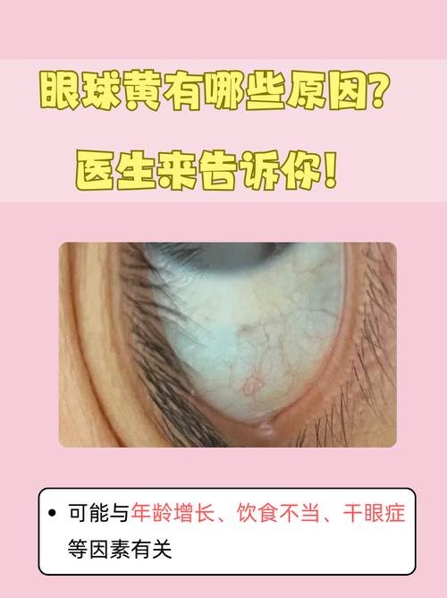 新生儿眼白发黄是黄疸吗？需要就医吗？-第1张图片-郑州医学网