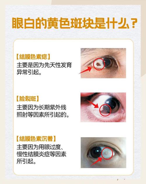 新生儿眼白发黄是黄疸吗？需要就医吗？-第3张图片-郑州医学网