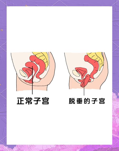 怀孕期间感觉子宫下垂,是孕期正常现象还是身体发出的危险信号?-第3张图片-郑州医学网 怀孕期间感觉子宫下垂,是孕期正常现象还是身体发出的危险信号?-第3张图片-郑州医学网