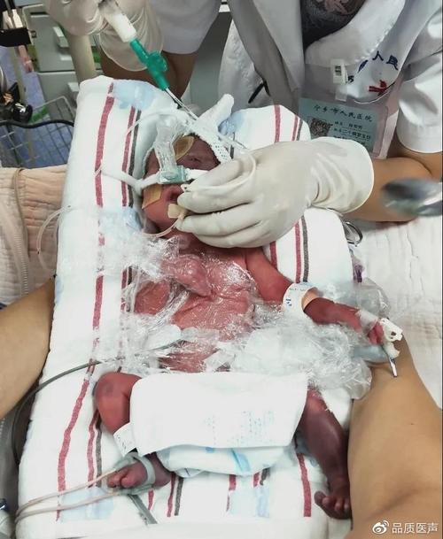 新生儿呼吸窘迫综合征的早期识别与治疗关键是什么？-第1张图片-郑州医学网