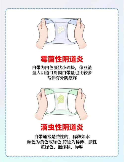 孕期出现乳白色白带是否属于正常现象？-第2张图片-郑州医学网