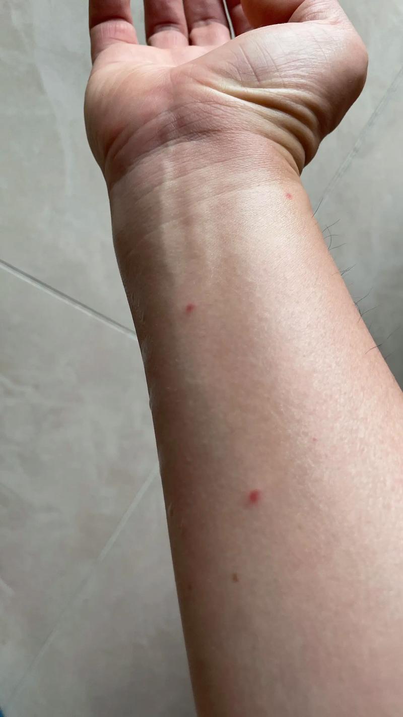 新生儿脸上突然长红点是过敏还是疾病信号？需要担心吗？-第2张图片-郑州医学网