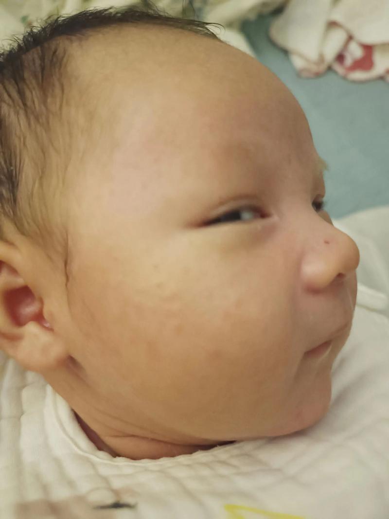新生儿脸上突然长红点是过敏还是疾病信号？需要担心吗？-第3张图片-郑州医学网