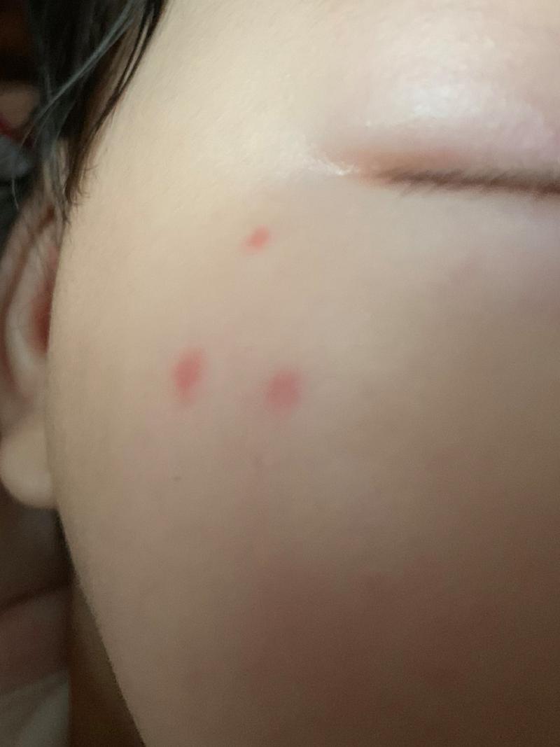 新生儿脸上突然长红点是过敏还是疾病信号？需要担心吗？-第1张图片-郑州医学网