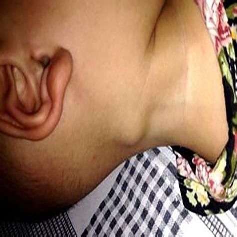 儿童腹腔多发淋巴结肿大是严重疾病吗?需要哪些检查和治疗?-第2张图片-郑州医学网 儿童腹腔多发淋巴结肿大是严重疾病吗?需要哪些检查和治疗?-第2张图片-郑州医学网