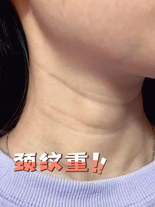 孕期脖子上突然出现三道纹,是皮肤异常还是身体预警信号?-第1张图片-郑州医学网 孕期脖子上突然出现三道纹,是皮肤异常还是身体预警信号?-第1张图片-郑州医学网