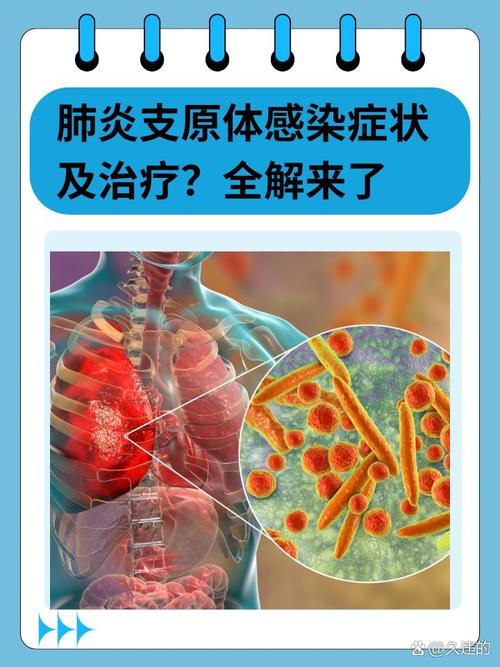 儿童肺炎支原体感染有哪些典型症状？家长如何早期识别与应对？-第3张图片-郑州医学网