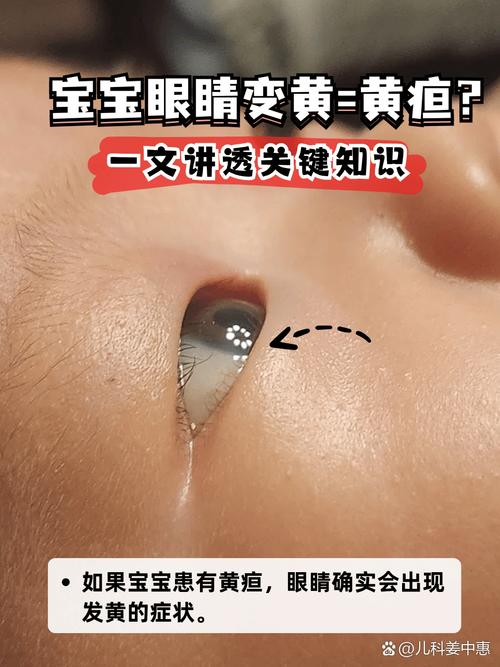 新生儿眼球发黄是黄疸吗？需要就医检查吗？-第1张图片-郑州医学网
