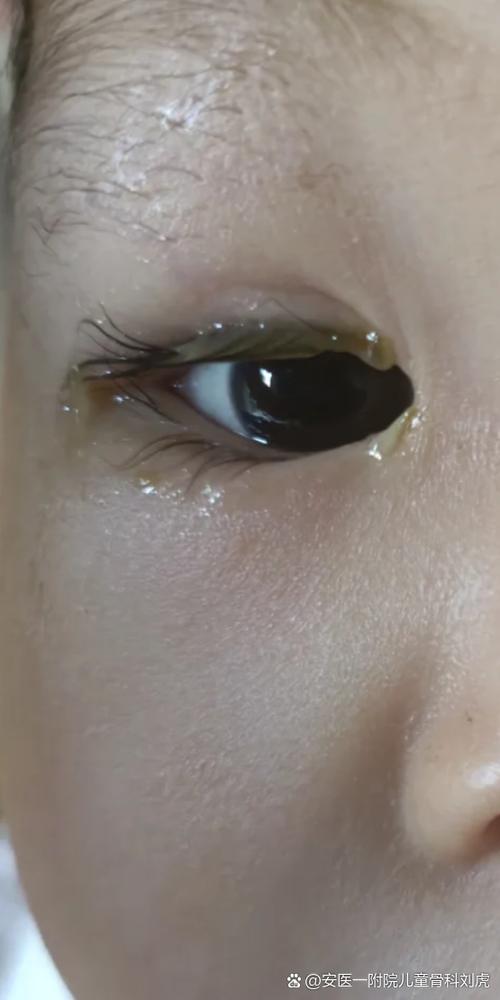 新生儿眼球发黄是黄疸吗？需要就医检查吗？-第3张图片-郑州医学网