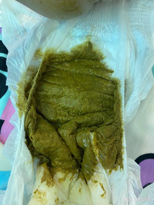 新生儿的大便为何呈现绿色？是正常现象还是健康预警？-第1张图片-郑州医学网