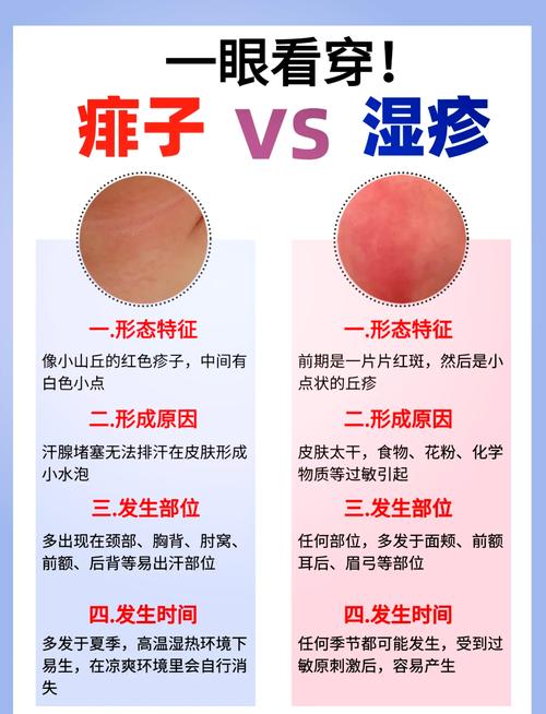新生儿座疮和湿疹的区别是什么？症状、成因及护理方法有何不同？-第3张图片-郑州医学网