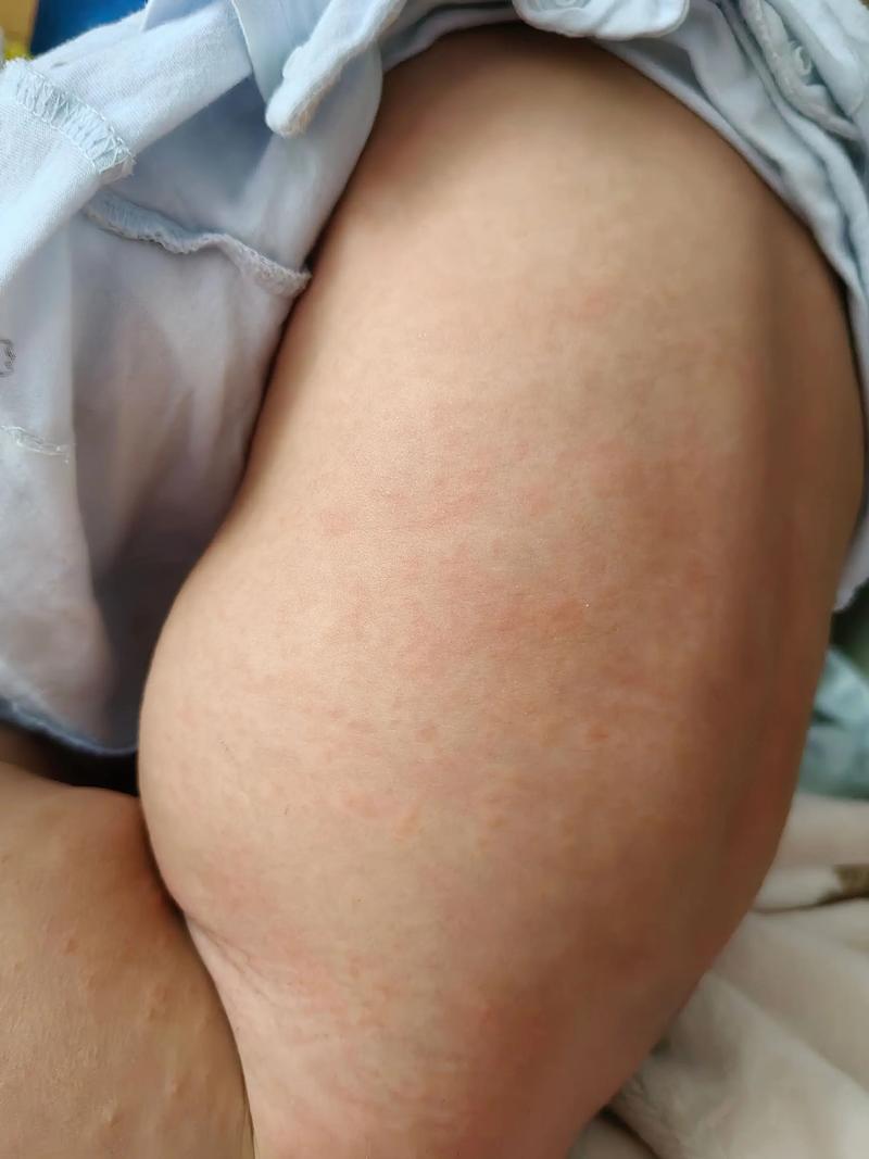 20天新生儿受凉会有哪些症状？如何判断和处理？-第2张图片-郑州医学网