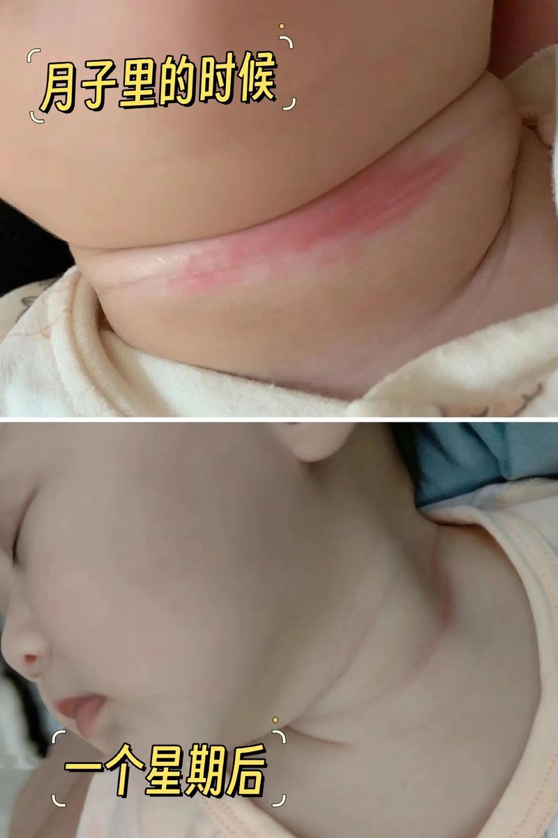 20天新生儿受凉会有哪些症状?如何判断和处理?-第3张图片-郑州医学网 20天新生儿受凉会有哪些症状?如何判断和处理?-第3张图片-郑州医学网