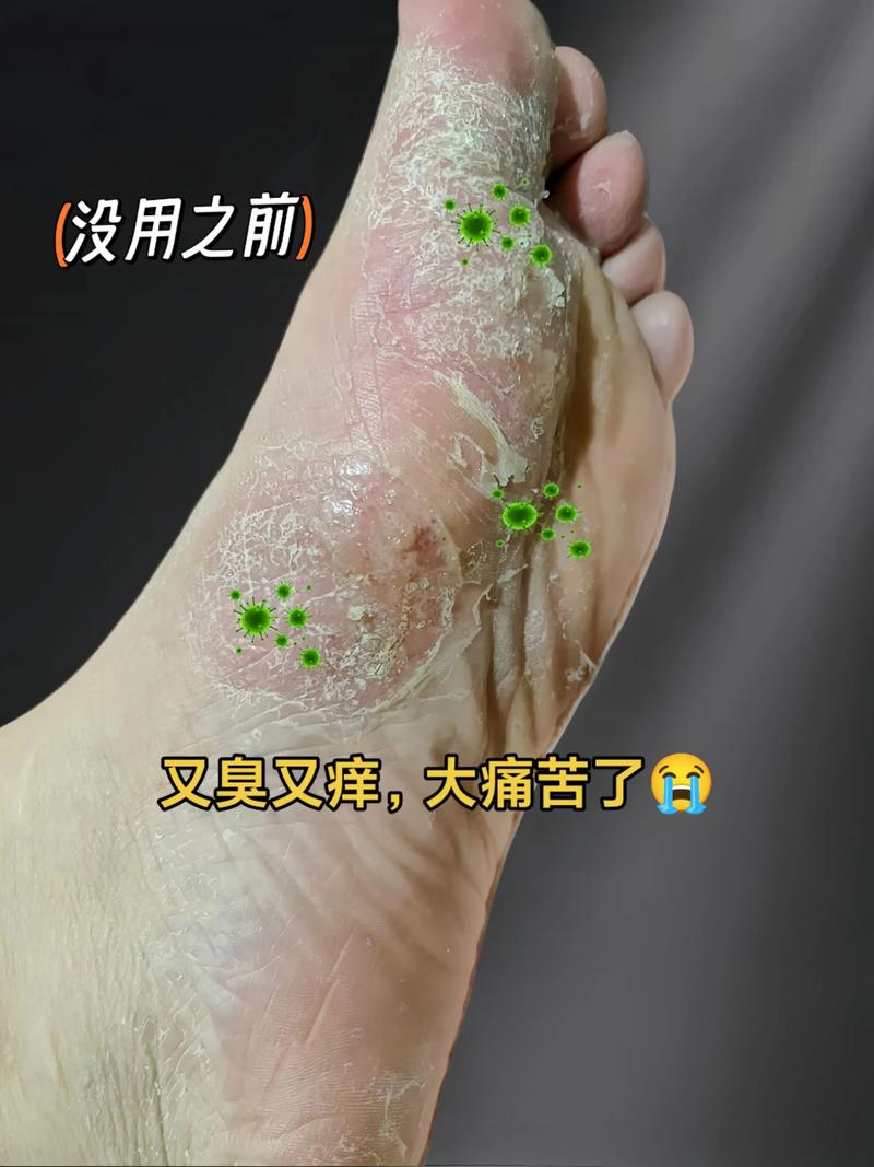 孕期脚心痒得受不了，是缺营养还是激素捣乱？怎么止痒才安全？-第3张图片-郑州医学网