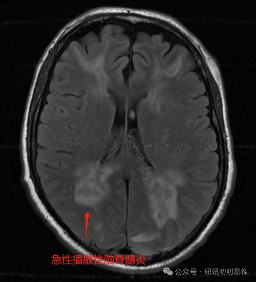 10岁儿童脱髓鞘怎么办？病因、治疗与康复全解析-第3张图片-郑州医学网