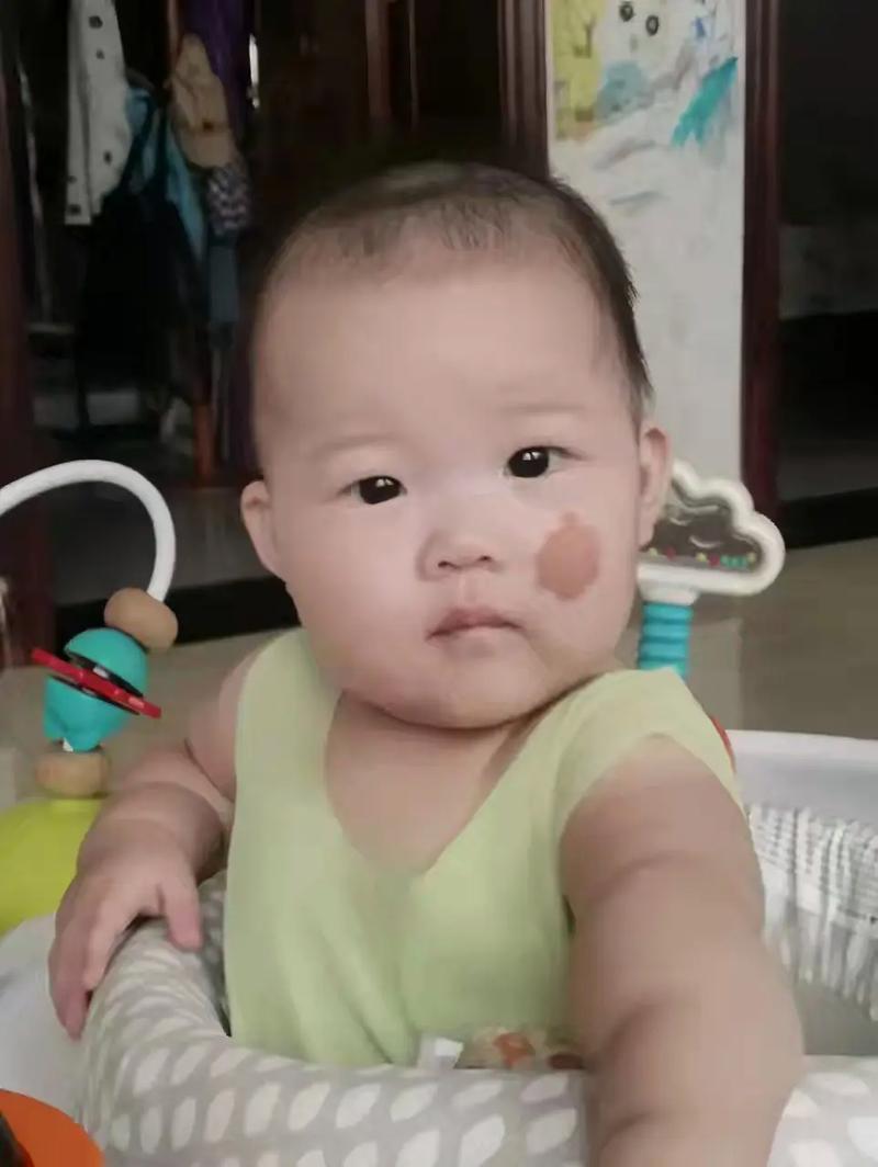 新生儿脸上的胎记需要处理吗？会不会自行消失？如何判断是否需要就医？-第1张图片-郑州医学网